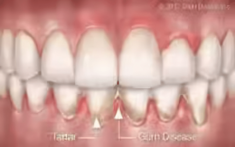 Gum Disease Treatments Henderson NV
