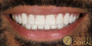 After Image: 10 veneers on top and 10 on the bottom