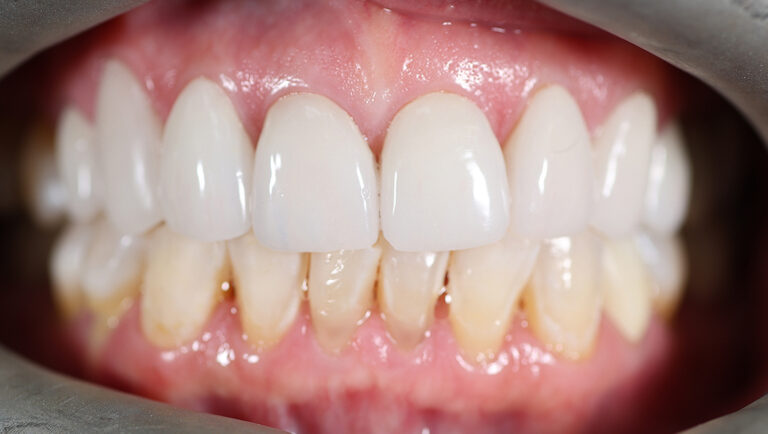 After Image: 8 upper veneers - front