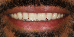 Before Image: 10 veneers on top and 10 on the bottom