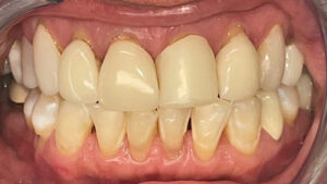Before Image: 8 upper veneers