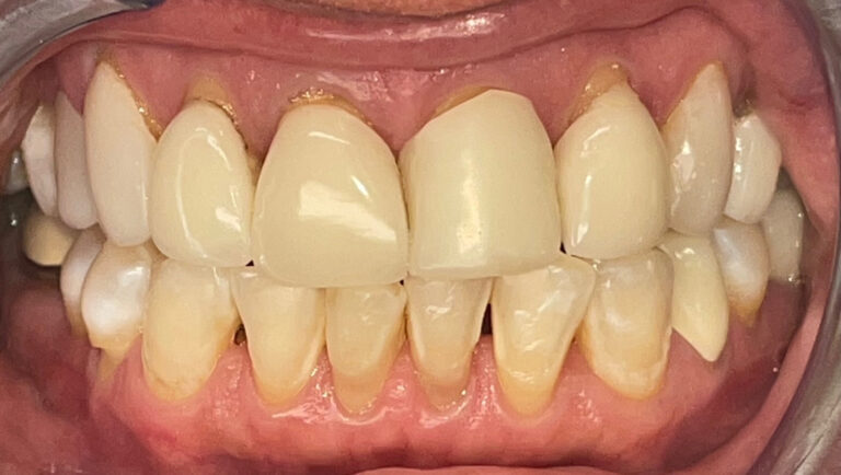 Before Image: 8 upper veneers - front