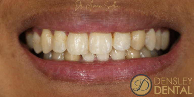 After Image: Invisalign - front