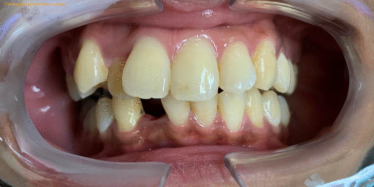 Before Image: Invisalign - front