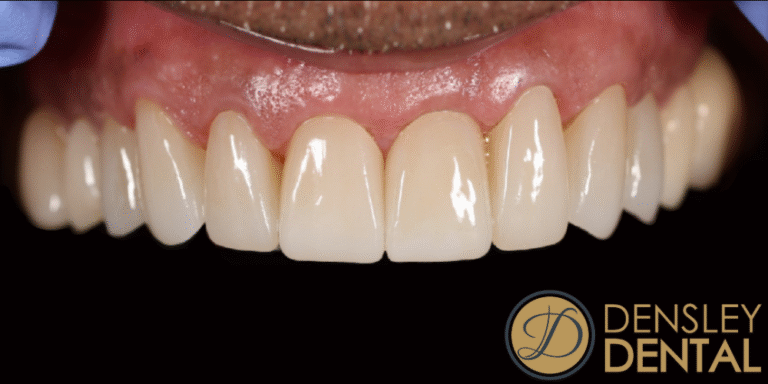 After Image: 8 upper veneers - front