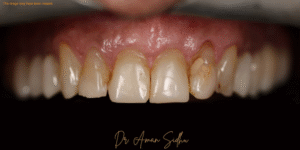 Before Image: 8 upper veneers
