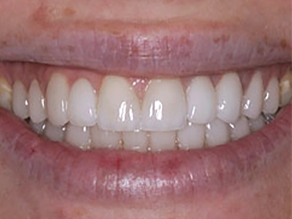 After Image: Two 3 unit bridges replacing missing teeth - front