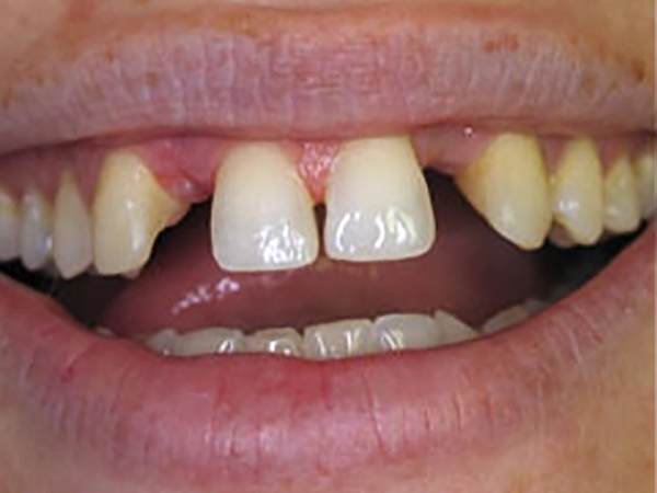Before Image: Two 3 unit bridges replacing missing teeth - front