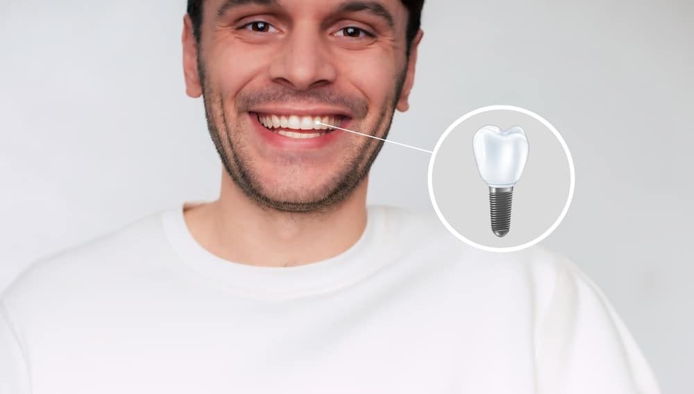 Smiling man with a diagram of dental implant to show how his smile was restored.
